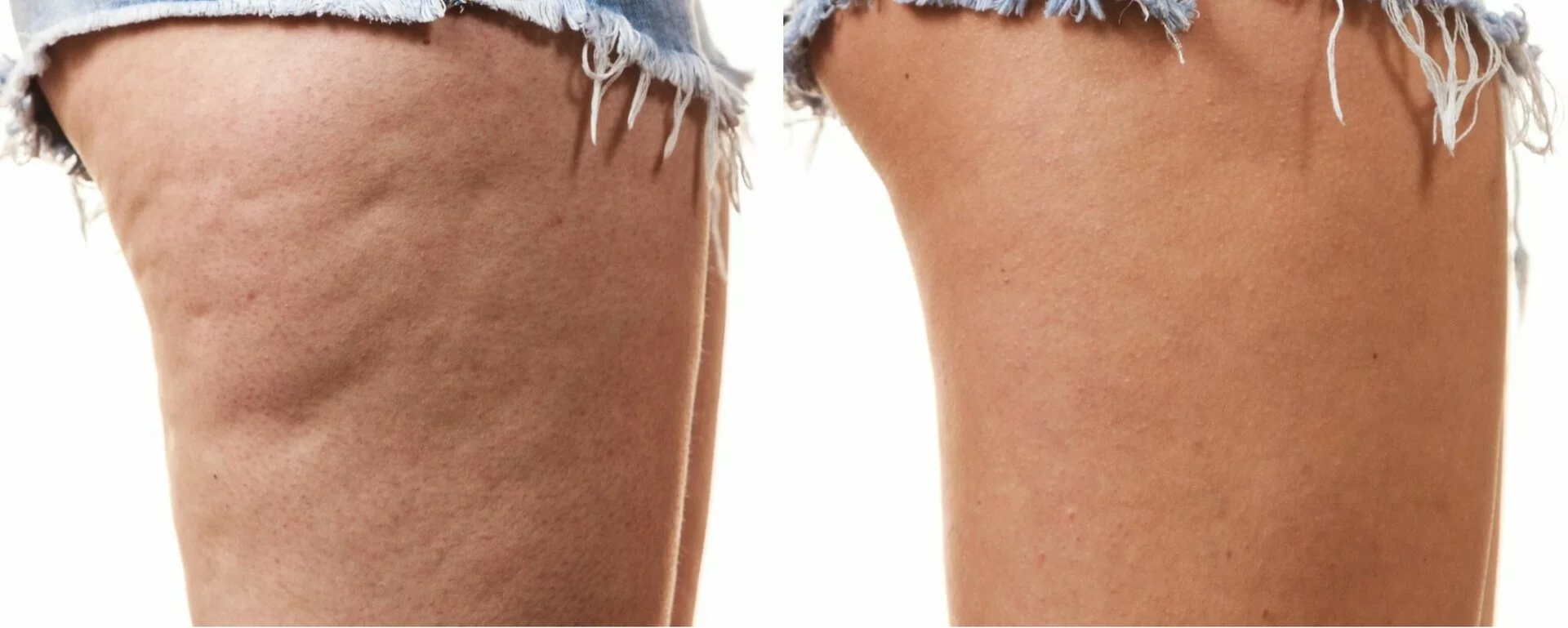 cellulite reduction hempshire